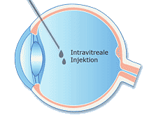 Intravitreale Injektion